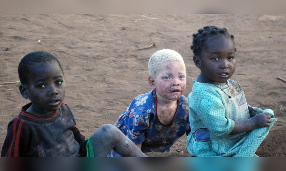 Por qué los albinos que viven en África deben usar un botón antipático