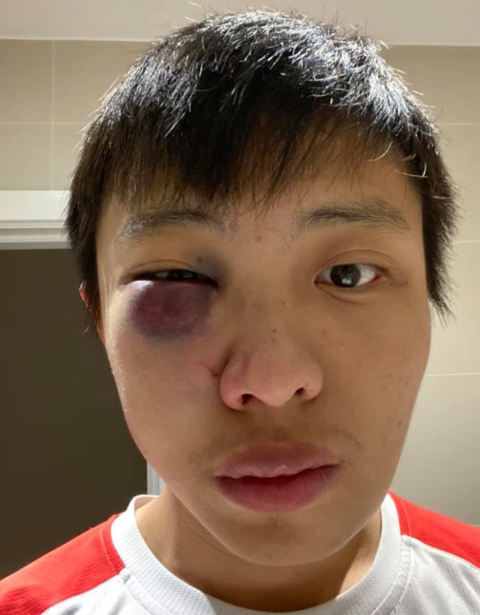 “No quiero tu coronavirus en mi país”, le dijeron a un joven asiático al golpearlo brutalmente