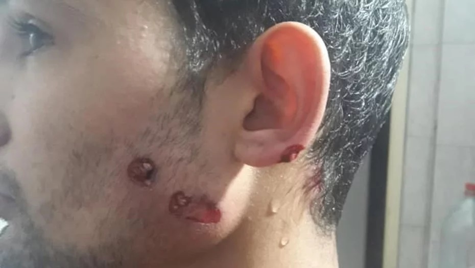 Salió a comprar y la policía le disparó con balas de goma por violar la cuarentena