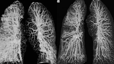 Imágenes impactantes muestran cómo el coronavirus daña los pulmones