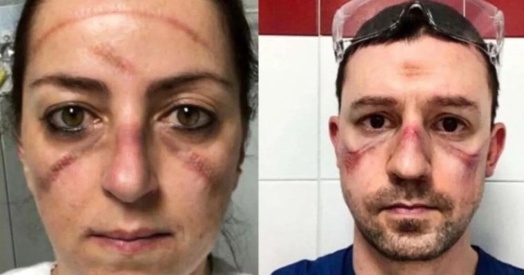 Las marcas en los rostros de los médicos italianos que luchan contra el coronavirus