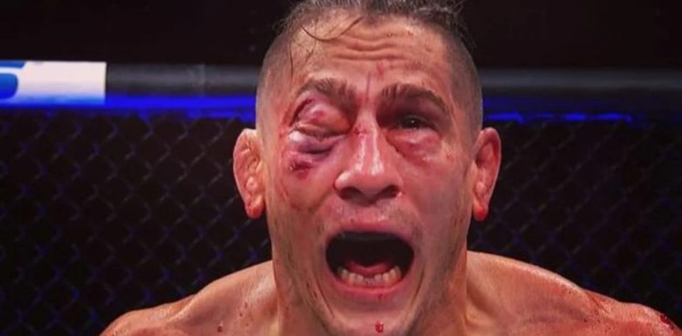 La impactante imagen de cómo quedó la cara de Niko Price tras perder por nocaut en la UFC 249