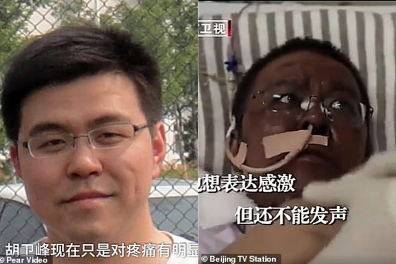 Coronavirus: murió uno de los médicos infectados en Wuhan cuya piel se tornó oscura tras el tratamiento
