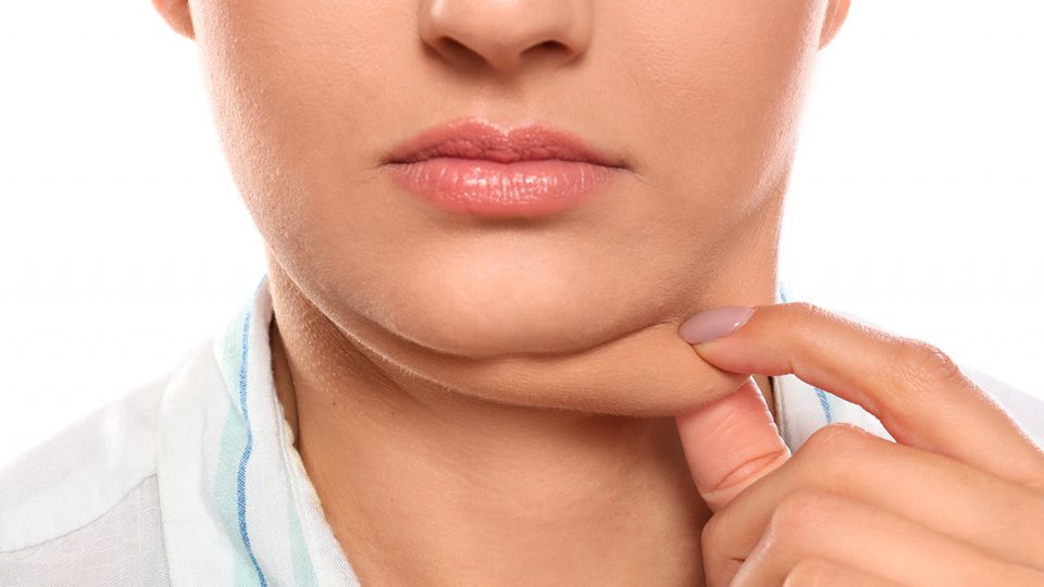 Aseguran que es posible eliminar la papada sin cirugía