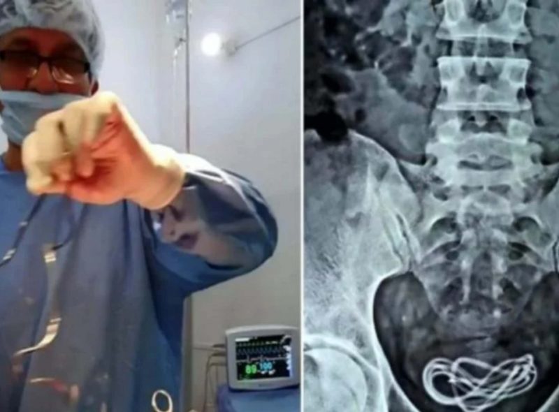 Fue al hospital por un fuerte dolor de panza y descubrieron que tenía un cargador de celular en la vejiga