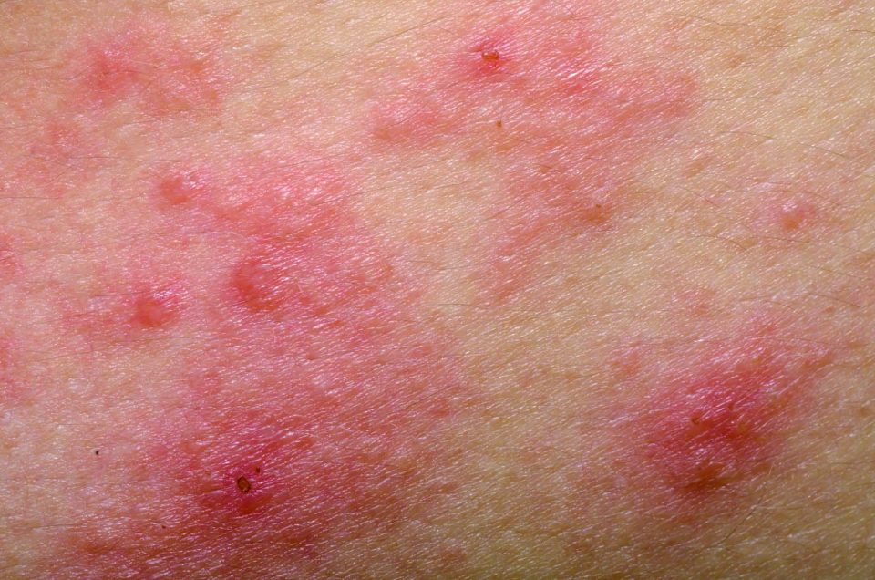 Las erupciones en la piel podrían ser un síntoma de coronavirus