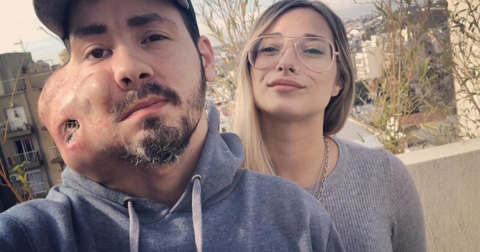 Tiene un violento cáncer en la cara, contó su caso y conoció a la mujer de su vida durante la cuarentena