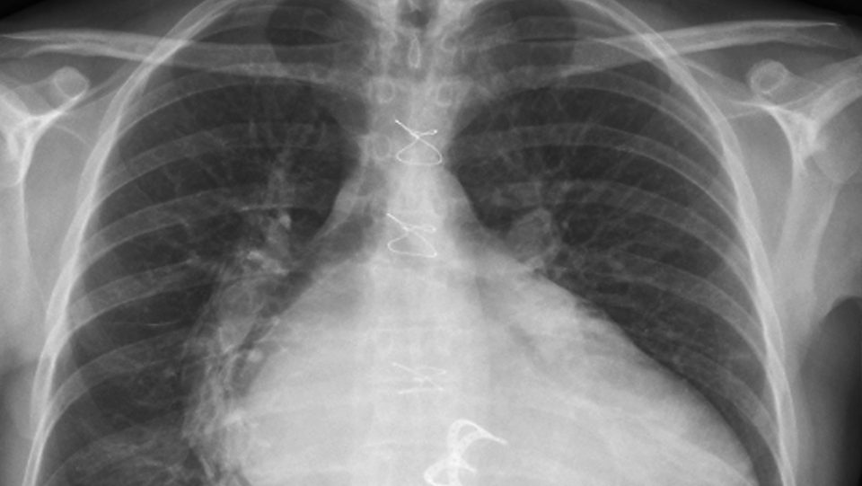 Creyeron que tenia un tumor, pero eran gasas olvidadas de una antigua operación