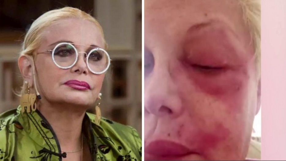 “Puedo perder un ojo”, el grave momento de salud que atraviesa Carmen Barbieri