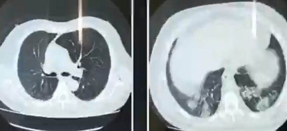 Coronavirus: así se ven los pulmones con y sin covid-19