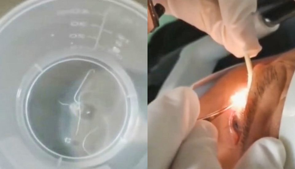 Tenía alojados más de 20 gusanos en sus ojos y lo operaron