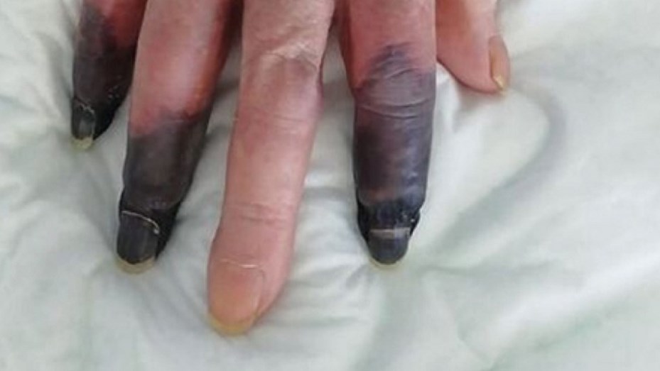 Perdió 3 dedos a raíz de una gangrena generada por el coronavirus